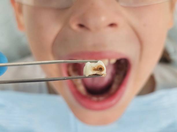 Best Emergency Dentist for Lost Fillings or Crowns in Pismo Beach, CA