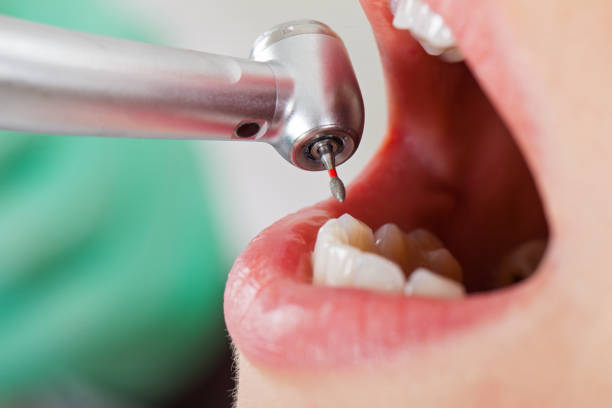 Best Emergency Dental Extractions in Pismo Beach, CA